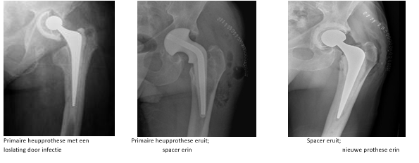 Regionaal Infectiecentrum Orthopedie | Amphia Ziekenhuis